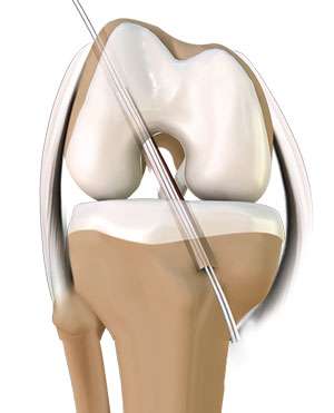 Anterior Cruciate Ligament (ACL) Reconstruction