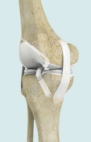 Anterior Cruciate Ligament (ACL) Reconstruction