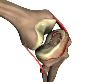 Meniscus Tear 