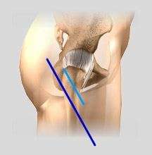 Minimally Invasive and Open Hip Replacement Incisions