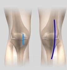 Minimally Invasive and Open Knee Joint Replacement