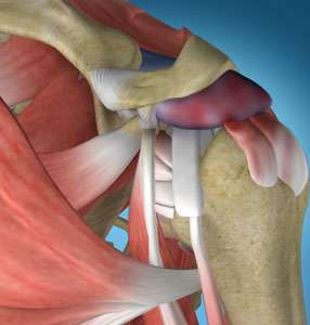  Shoulder Impingement 