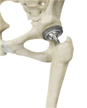 Total Hip Replacement (THR)