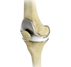 Total Knee Replacement (TKR) 