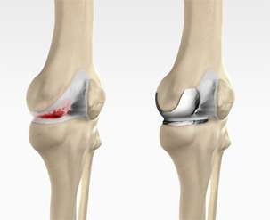 Unicondylar Knee Replacement